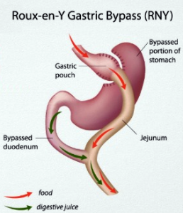 Gastric Bypass Surgery RNY