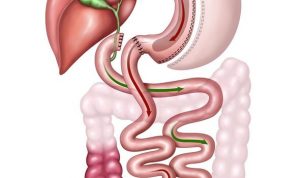 Duodenal Switch Surgical Procedure