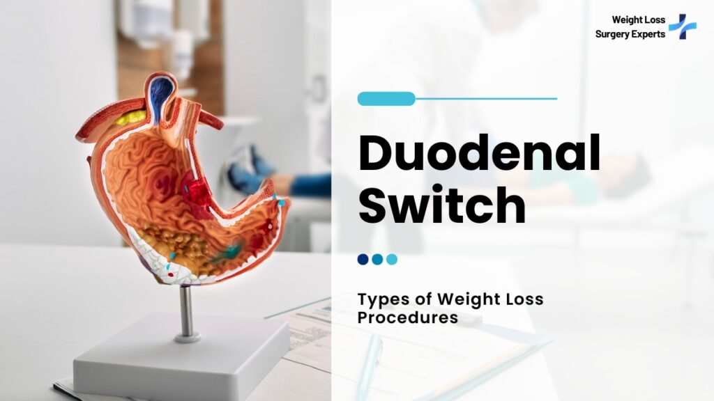 Duodenal Switch-Weight Loss Surgery Experts