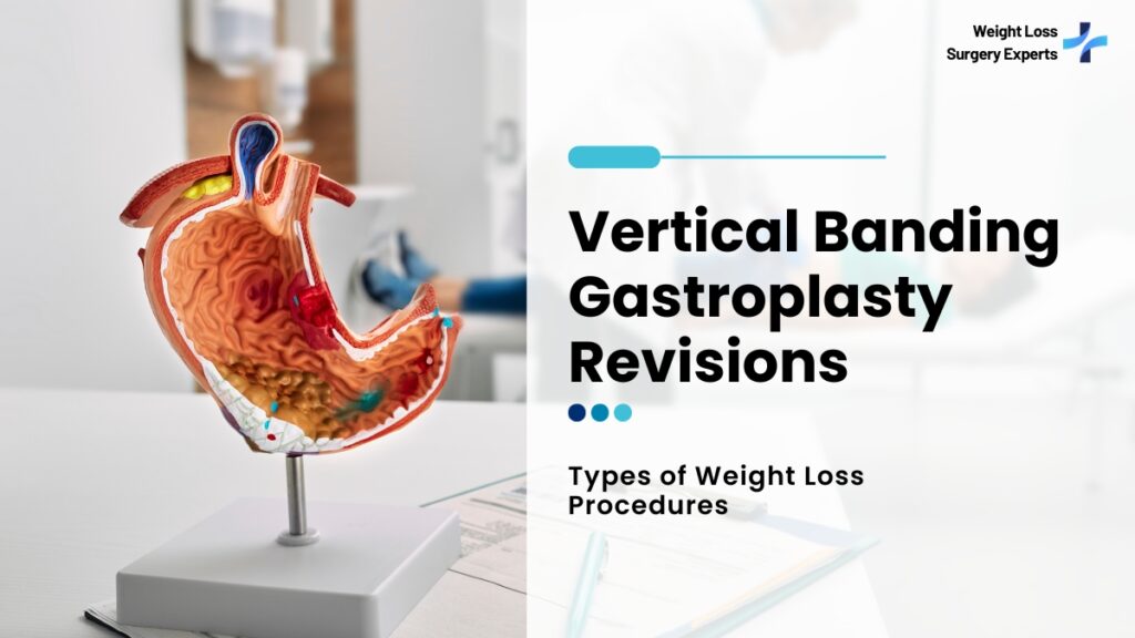Vertical Banding Gastroplasty Revisions-Weight Loss Surgery Experts